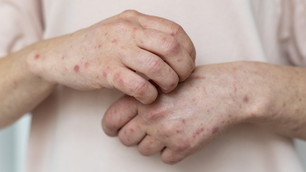 Urticaria en la Piel
